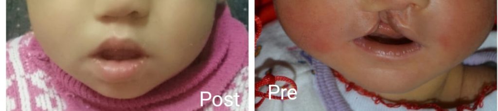 Cleft lip surgery before and after